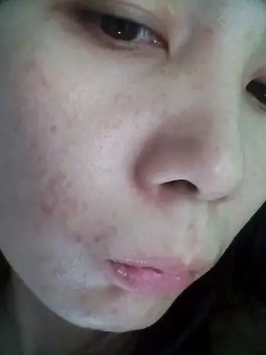 毛孔严重堵塞而且长了很多小疙瘩怎么办?