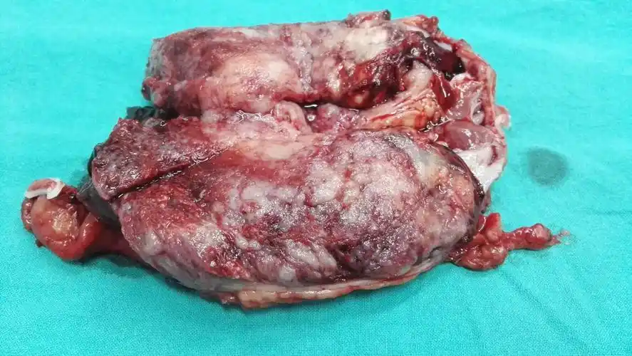 罕见病-孤立肾残存输尿管肿瘤_输尿管肿瘤_输尿管肿瘤介绍 - 好大夫