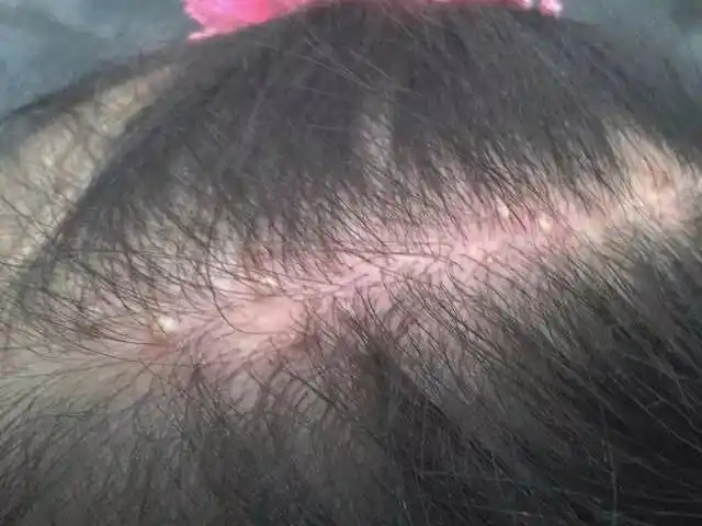 头皮脓包:头皮毛囊长期被赌塞,毒素无法排出,长期蓄积在头皮表皮下