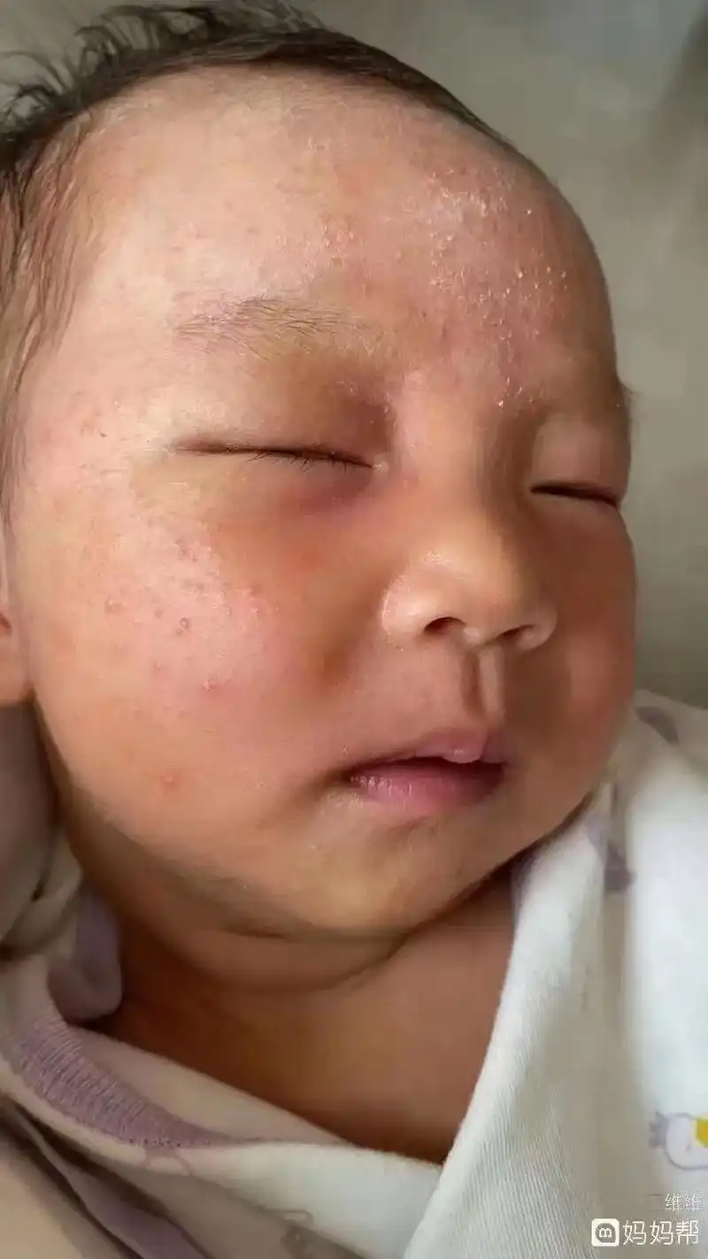 93不要再说:湿疹没关系,大了就好了. - 抖音
