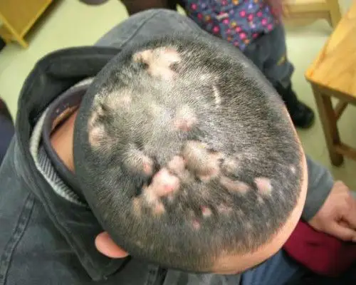 头皮癣早期症状图片5