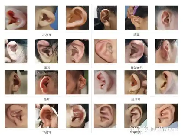 耳廓是五官美学的重要组成部分!出现这些情况,请注意可能是耳畸形出没