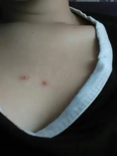 胸口长这两个红疙瘩很长很长时间了,不痛也不痒