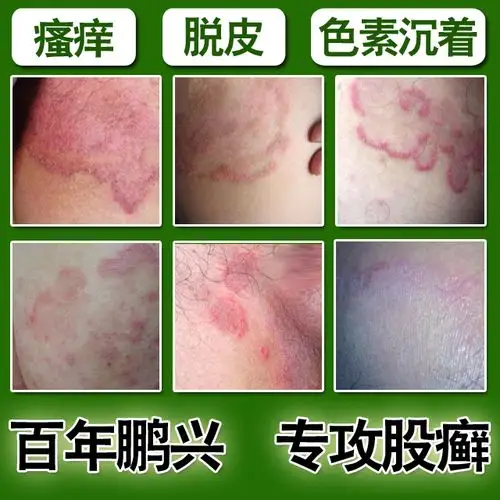 鹏兴股癣特效根治疗股廯体藓色素股清膏阴囊肛门湿疹喷剂止痒脱皮