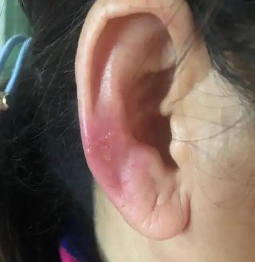 耳朵上长疱也是带状疱疹的一种类型,和长身上的是一样的,都是由水痘