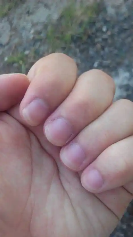 手指甲翻紫色怎么回事?