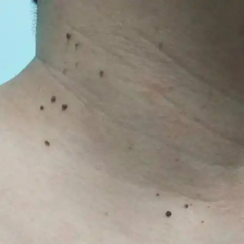 西安小伙脖子上长"小肉揪",居然是hpv感染.