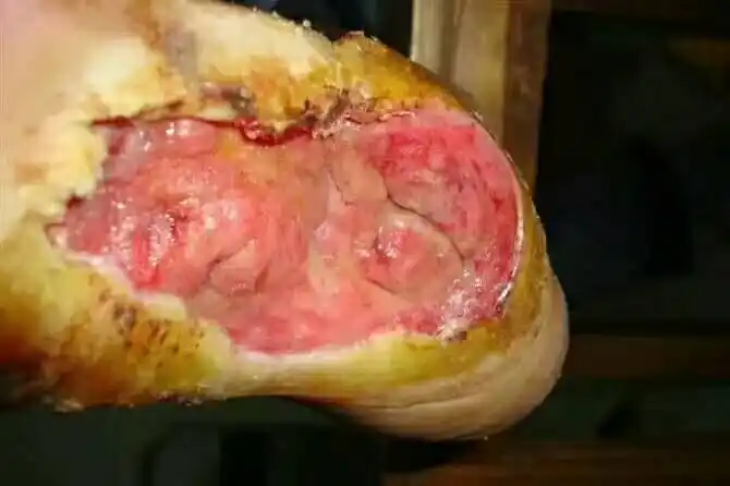 难愈性皮肤溃疡,糖尿病足坏死一站式治疗.(医学专科资料胆小勿视) -