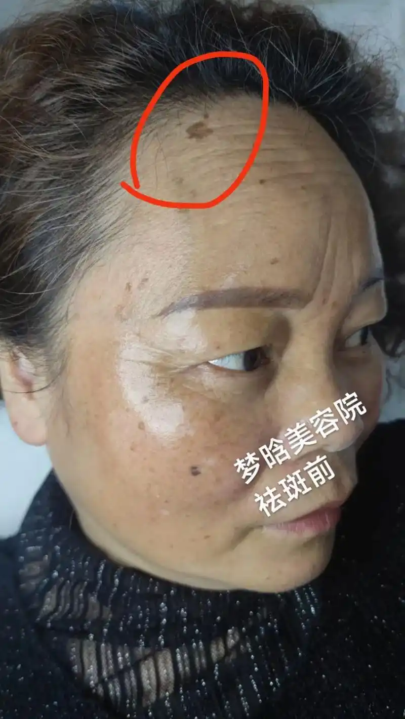 修复后角质层明显变厚了#解决任何皮肤问题 #让我们一起变美  - 抖音