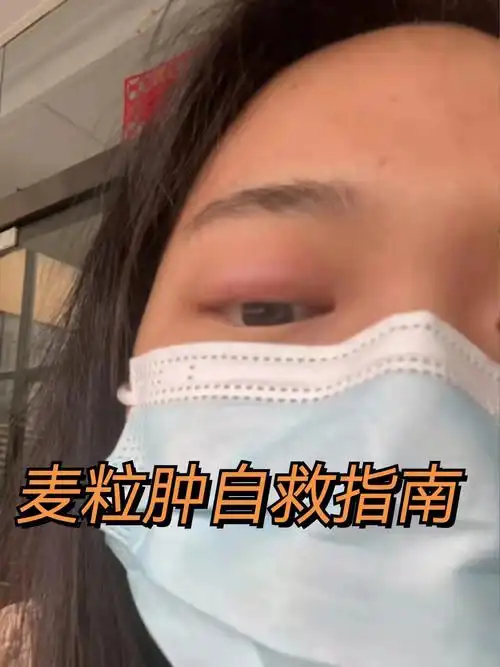 关于麦粒肿的小妙招自救指南