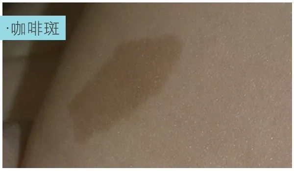 郑州美莱好不好 分斑分治 解决皮肤万"斑"烦恼