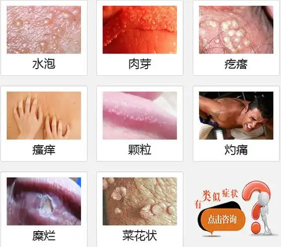 阴茎瘙痒长水泡怎么回事_阜阳友好医院男科官方网站_阜阳男科医院