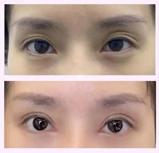 重庆微创双眼皮—自然无痕_双眼皮_素颜_肌无力_化妆_重庆双眼皮_美妆