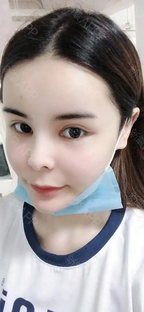 自体脂肪填充全脸