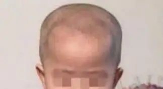 孩子的头大头小偏头方颅是什么原因一次性弄清楚