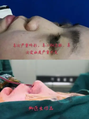 binder综合征也就是中面部凹陷患者如何做出自然的美鼻