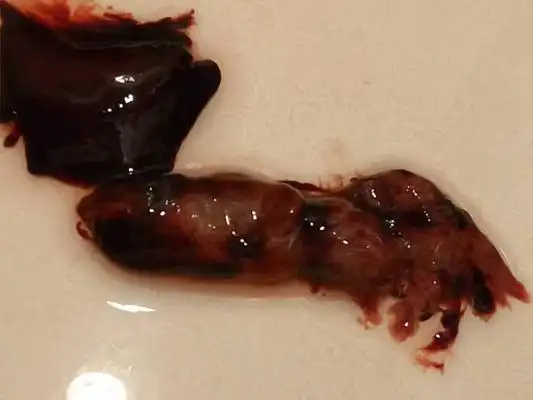 流产掉下来的孕囊图片 (50)