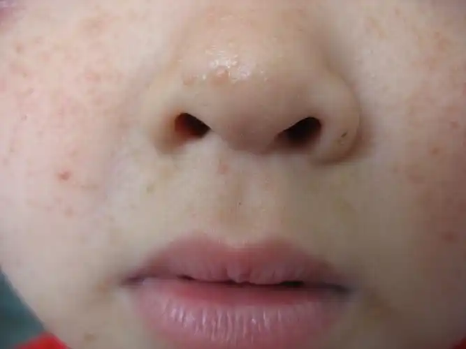 神经纤维瘤早期图片_有来医生