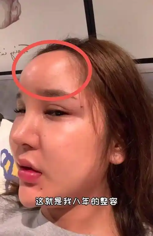 网红揭秘整容后遗症,假体下滑,玻尿酸被撑松,看上去很僵硬_影响_网络