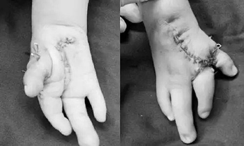 幼儿双手畸形如龙虾钳 或因辐射等影响所致(图)