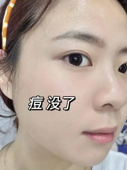 熬夜长痘油皮学生党看这祛痘淡印666