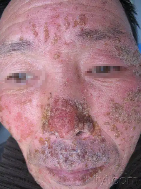 典型病历欣赏.(传染性湿疹样皮炎)