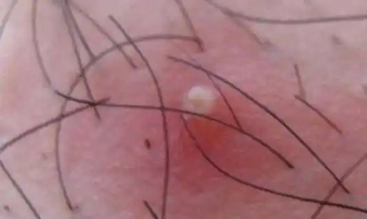 毛囊炎可以运动吗