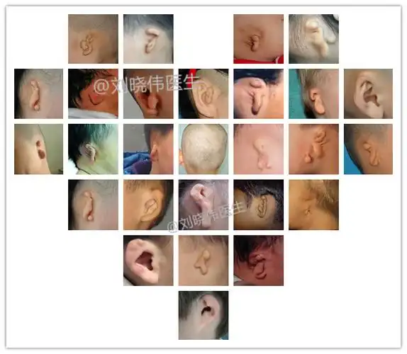 你可能不知道的耳朵畸形!