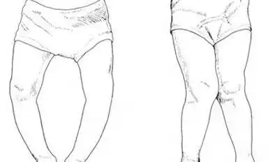 宝宝学走路外八字,15个月宝宝走路有点内八字怎