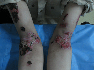 皮肤因为艾滋病都遭受了什么