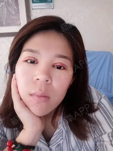 今天是我做双眼皮的第二天给你们看看照片