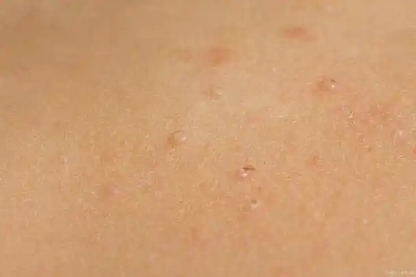 扁平疣用碘伏能治吗?