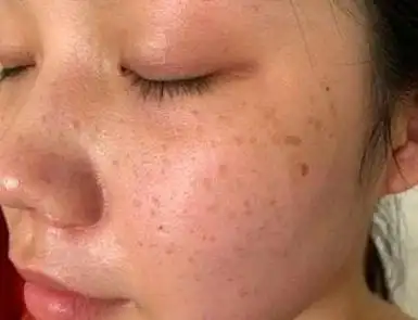 28岁女子皮肤长斑不重视,确诊肝癌,医生叹息:2个习惯要不得_网易订阅