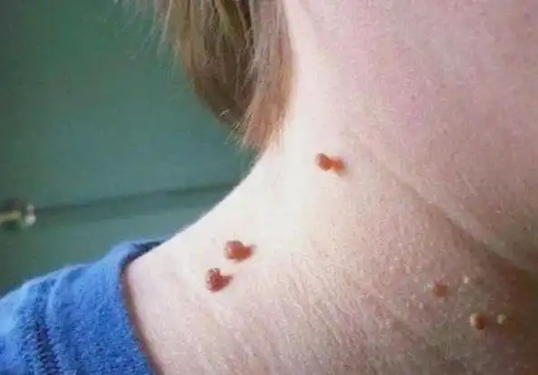 脖子上长小肉疙瘩患者多吗(脖子上长出小疙瘩)