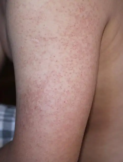 4条回答  2013-05-24 12:00 钻头爸|八级 可能是毛孔堵塞,注意清洁