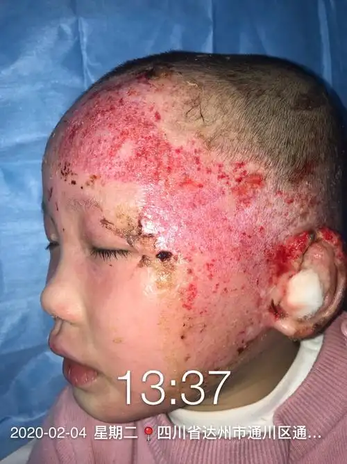 一例小儿头面部深二度烧伤,案例分享