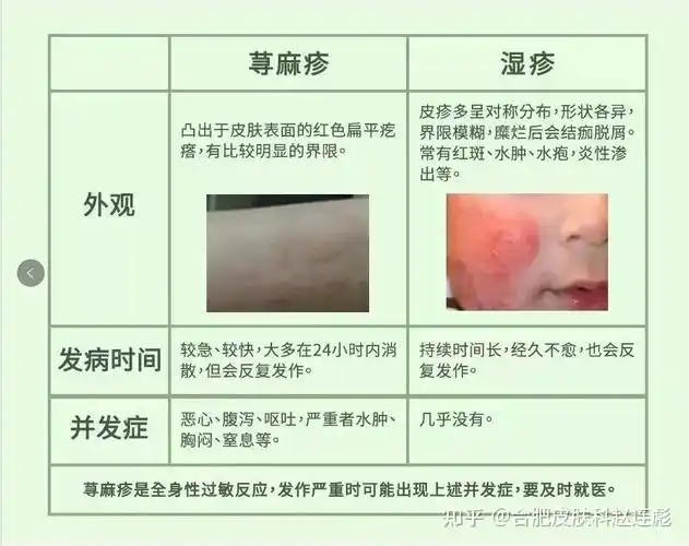 如何区分寻麻疹和湿疹
