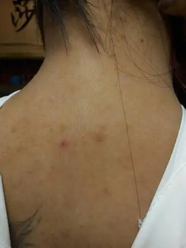 展开全部 也有可能是疥疮,睡了不干净的被子,挨着不干净的床单内衣