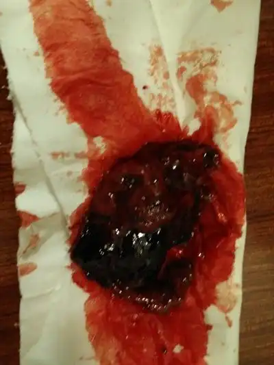 做了血肿清除,目前产后9天,b超显示宫腔内还有较多积血,能否吃益母草?