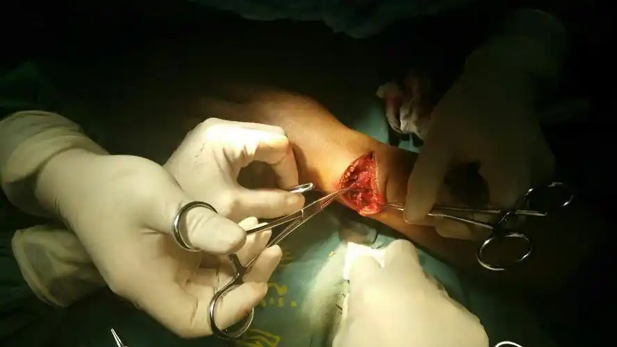 【2017年3月8日】刀砍伤左前臂清创探查血管,肌腱损伤修复术