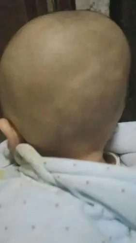 宝宝7个月了后脑还是这样的正常吗