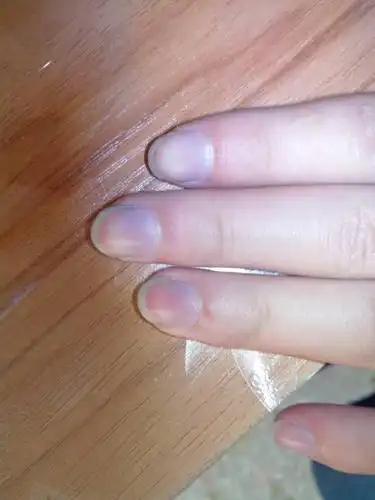 手指甲发紫是怎么回事?是不是中毒,会死吗?