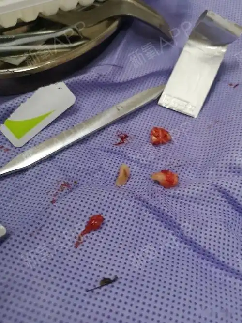 牙套中|25岁大龄正畸 拔牙六颗 牙套64天虎牙拜_圈子-新氧美容整形