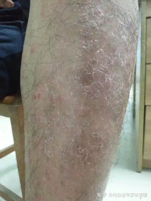 8%,总胆固醇6.46mmol/l,甘油三酯6.65mmol/l,诊断为"2型糖尿病