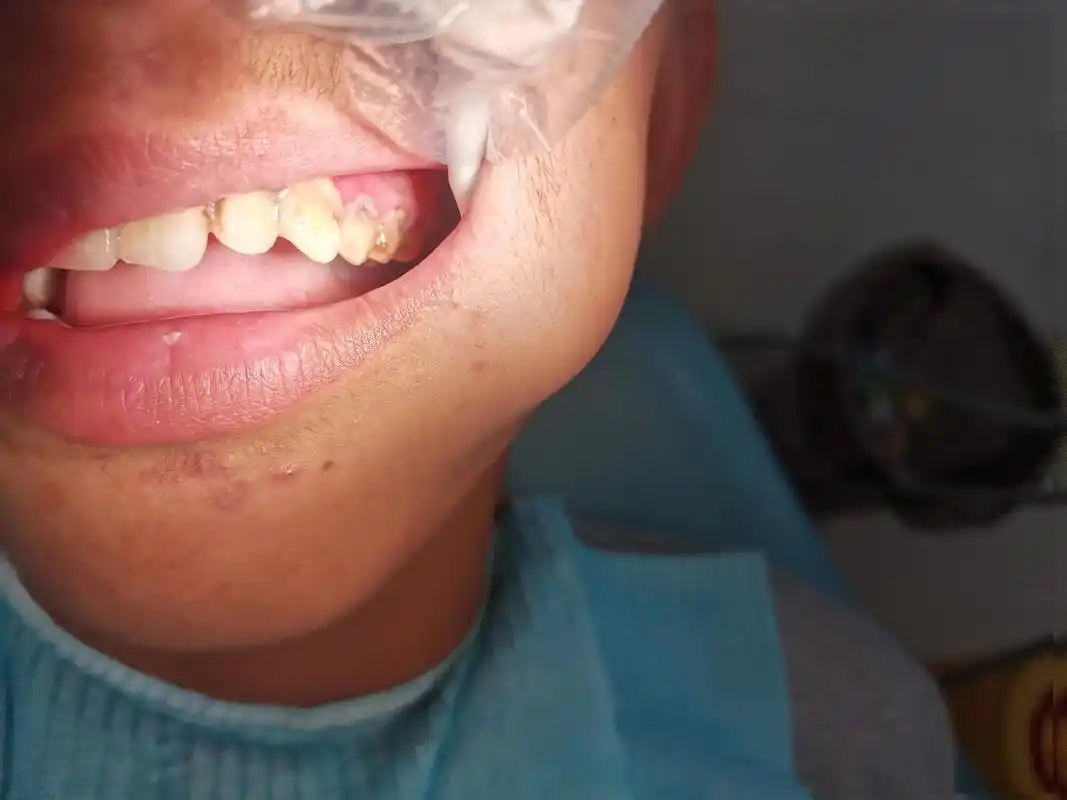 长期不刷牙会造成菌斑的附着,牙齿的破坏,牙龈炎症,红肿出血 - 抖音