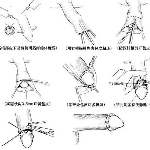包皮手术