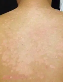 3白斑病在发病的早期数目是不一定的,也可能会有一两块白色斑块的产生