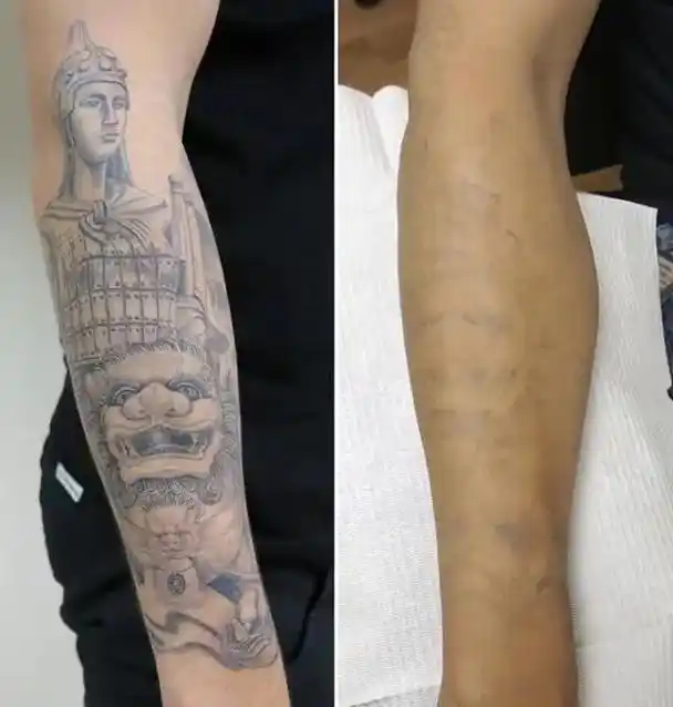 洗纹身真实案例