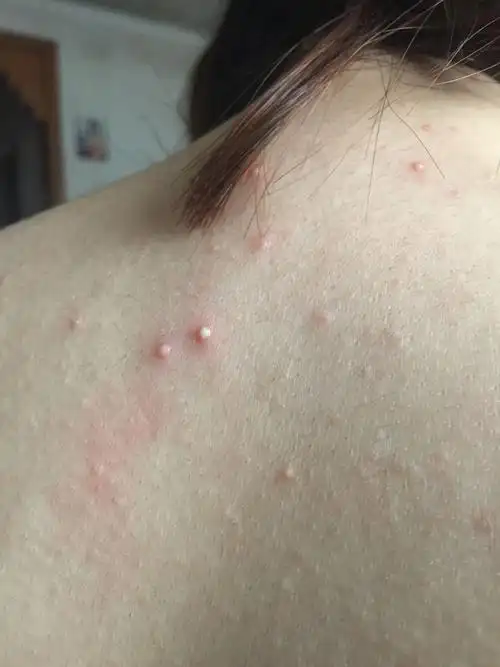 背部长痘痘有什么偏方治疗吗?