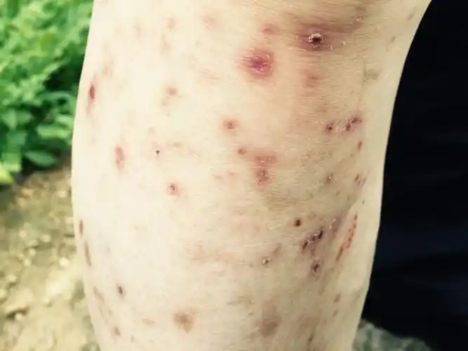 小腿烂了 不知道怎么回事 大家看看